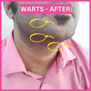 After Warts Homeopathic Treatment warts are gone From Beard Area